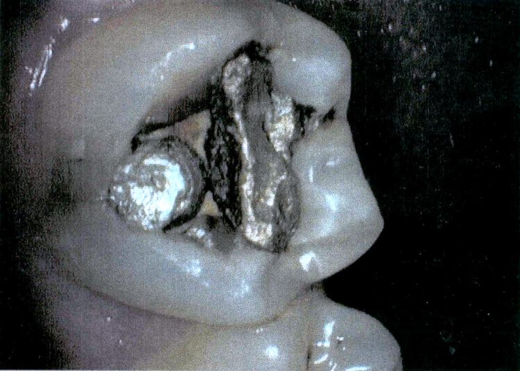 Composite or “Tooth Colored” Fillings - Albany