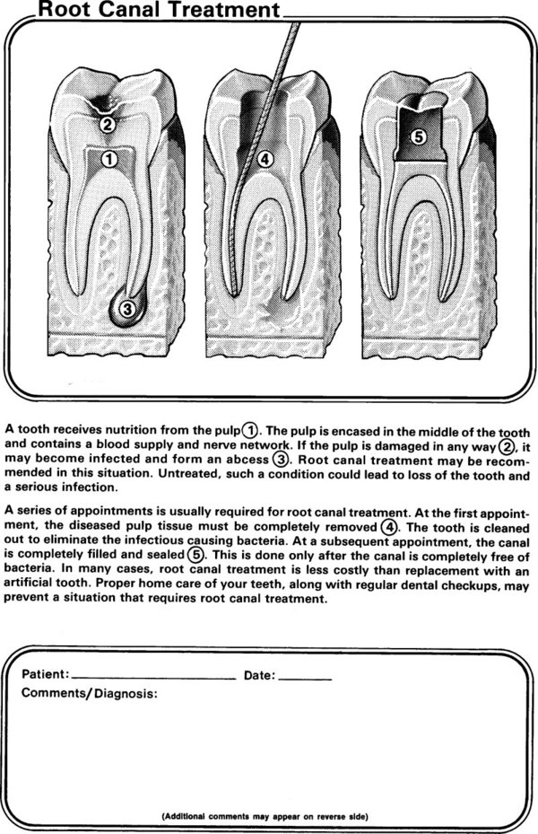 Root Canal Treatment