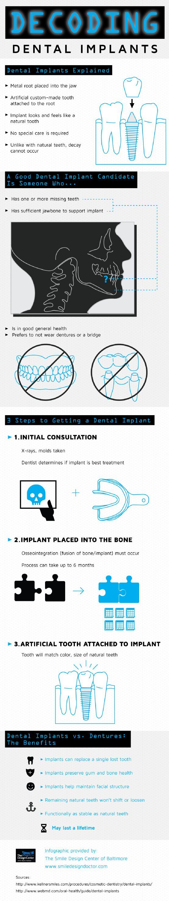 Decoding Dental Implants
